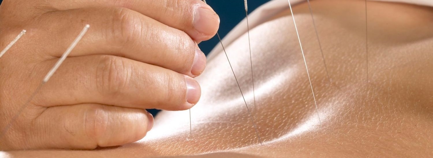 L'Acupuncture, l’harmonie par l’aiguille